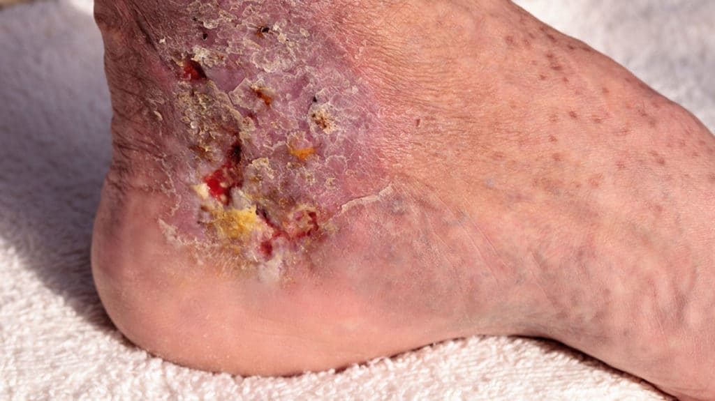 wunden heilen ulcus cruris