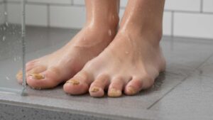 Wunden Heilen - Wunheilungsstörungen vorbeugen Nagelpilz Nagellack