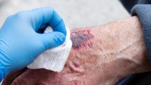 geschwuer heilt nicht